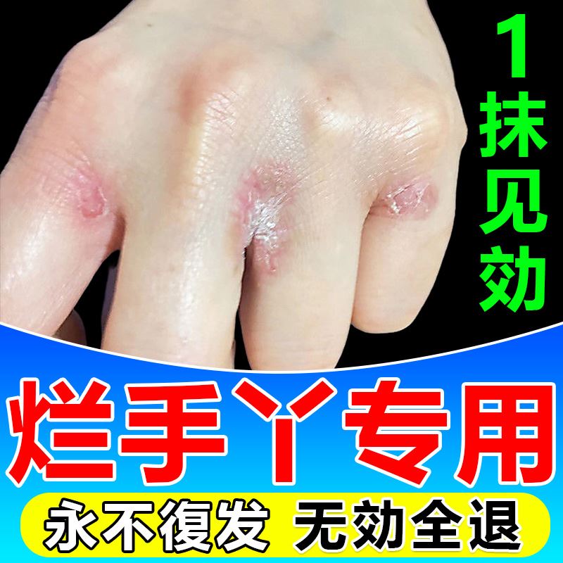 烂手丫手指缝溃烂手癣膏脱皮干裂真菌感染手上小水泡止痒专用药膏