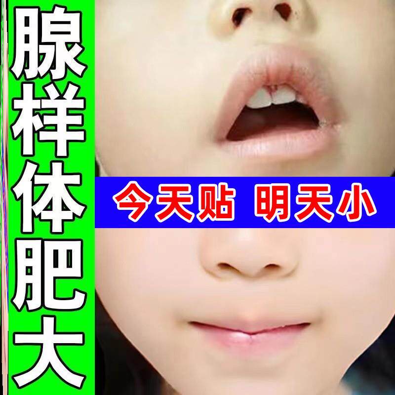 推荐【万人见证】腺样体肥大面容矫正器儿童张嘴呼吸腺样体肥大中