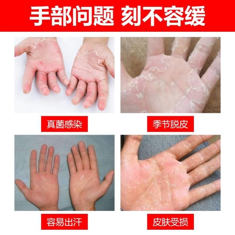 症干裂汗剥脱防手脱皮严重疹松懈孢E角质专膏修复霜治季节性鹅掌