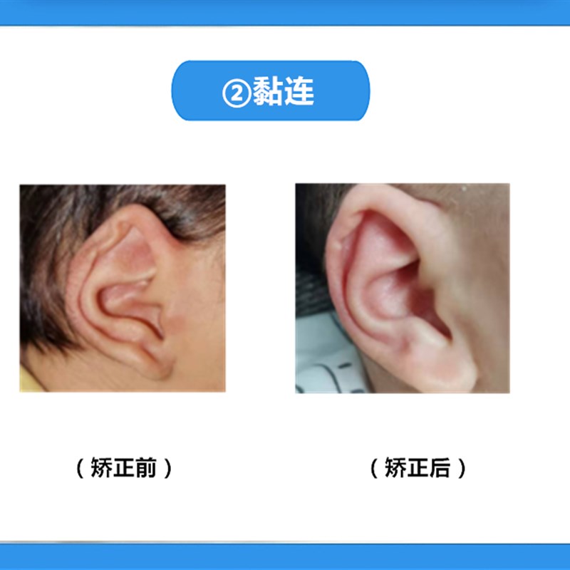 耳朵矫正器婴儿垂耳招风耳新生的儿宝宝耳朵定型纠正耳廓畸形耳夹