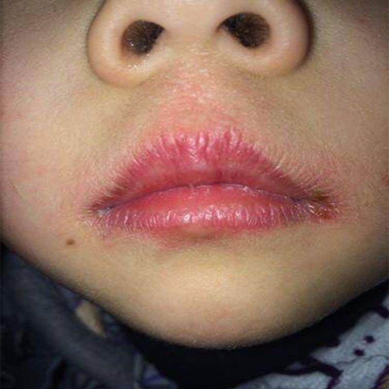 小孩舔嘴唇c口周唇炎红肿疼痛开裂脱皮【现发】嘴周一圈红起皮外