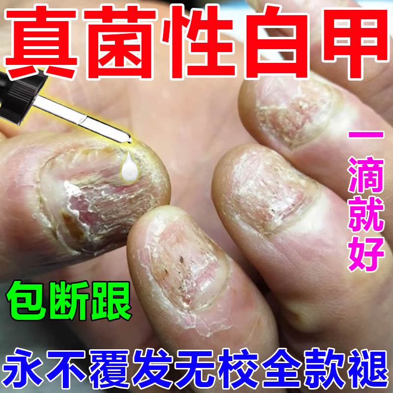 真菌性白甲脚指甲盖变厚甲床分离空甲坏指甲黄黑白修复液受损再生