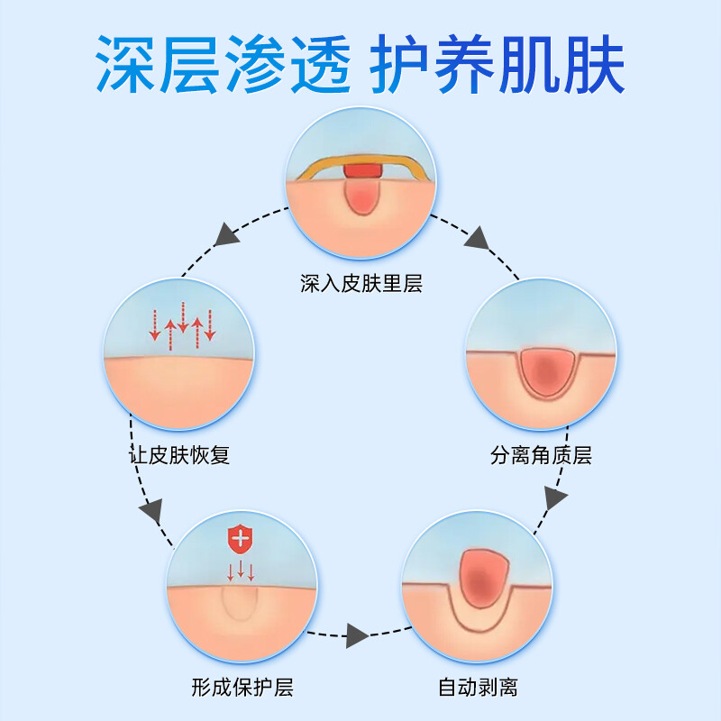 推荐水杨酸鸡眼贴跖疣寻常疣肉刺瘊子灵专用护理盒辅助去除足部祛