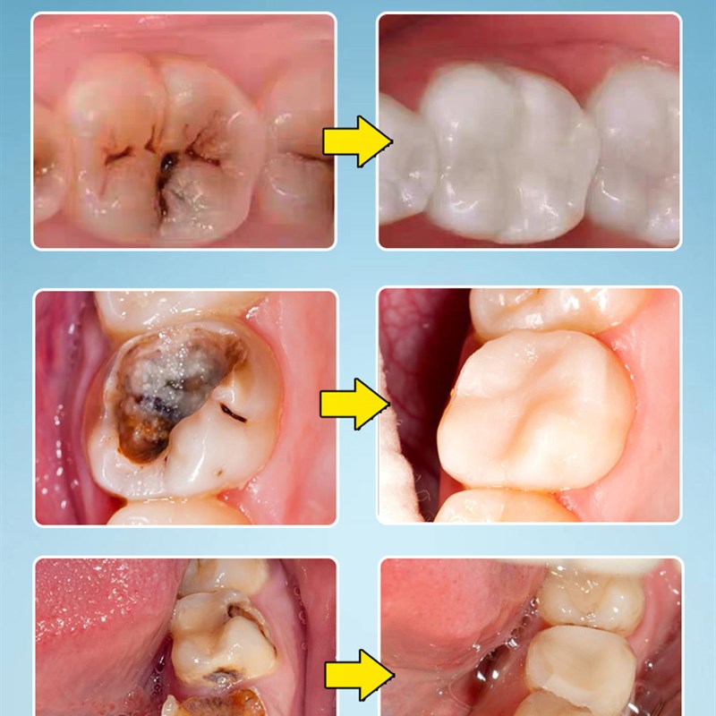 速发补牙齿洞膏补牙缝修复蛀牙自己填牙洞修补神器清理防虫牙龋齿