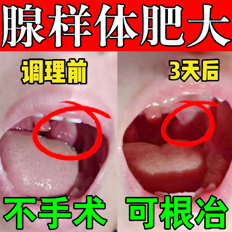 热销腺样体肥大中药贴调理儿童张嘴睡觉打呼噜鼻塞口呼吸面容矫正