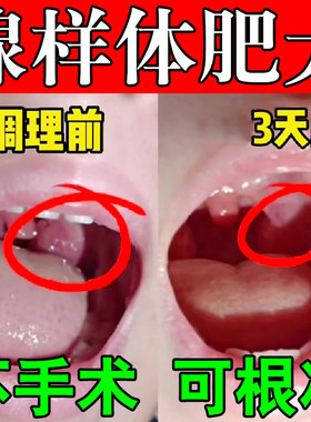 热销腺样体肥大中药贴调理儿童张嘴睡觉打呼噜鼻塞口呼吸面容矫正