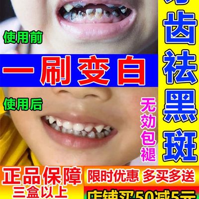 极速儿童去牙菌斑祛除神器去黑牙黑斑黑渍污垢清洁黄牙膏含氟美白