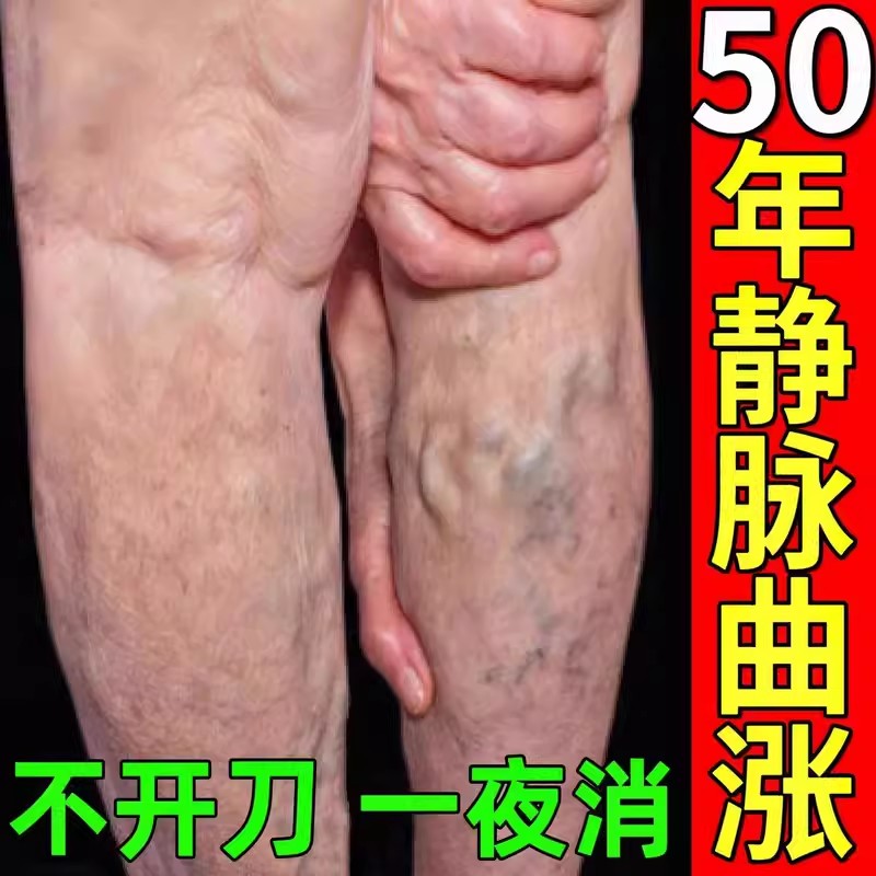热销201%冶好曲张】静脉曲涨特效膏抹平老烂腿神器青筋凸起冷敷凝