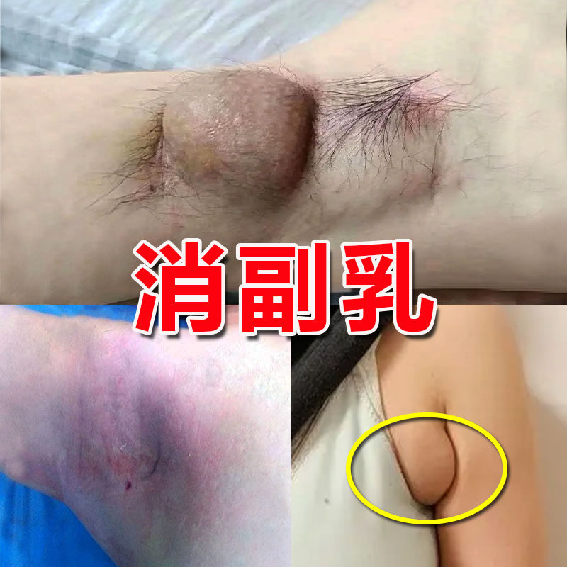 新品副乳消除贴【用过的都推荐】去副乳神器腋下淋巴疏通矫正膏药