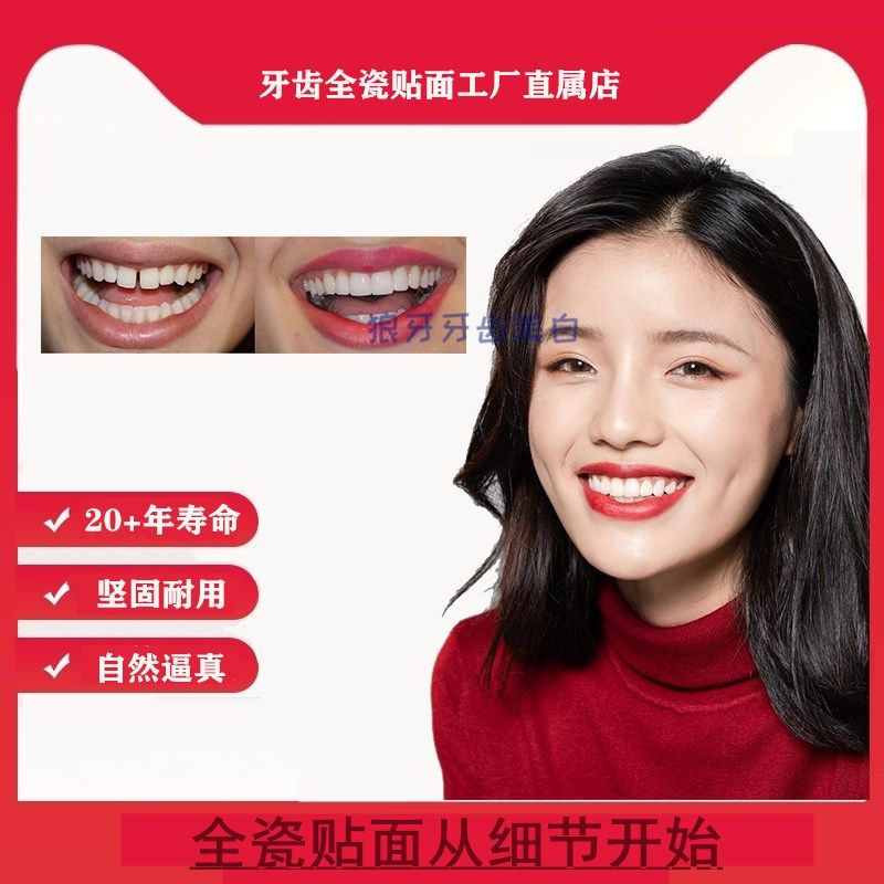 全瓷贴片美加义获嘉o超薄硬全瓷贴面琥珀瓷蓝瓷美牙贴面牙齿美白