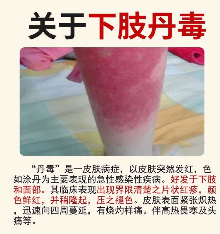 新品治疗丹毒症银屑病色素过敏皮炎四肢血管炎皮下出血紫瘀斑专用