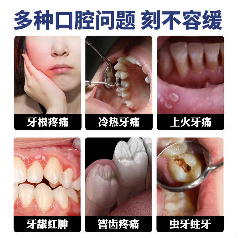 速发牙痛牙疼止疼药速效牙痛宁牙齿痛牙龈脓包肿包虫牙喷剂牙龈肿