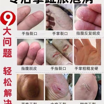 急速发货掌跖角化症角化病掌趾脓疱病掌跖脓包病手脚蜕皮乾裂角皮