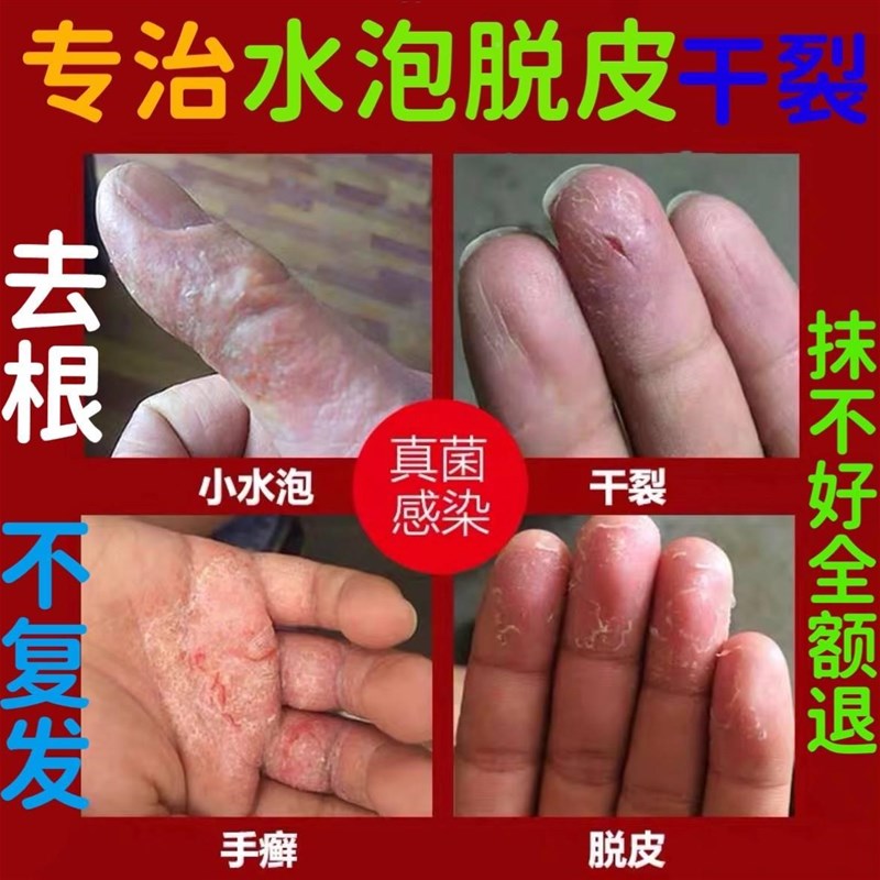 汗泡泡疹疱手上脱皮汗孢疹汗状孢疹专用药膏手痒起小水疱干裂软膏