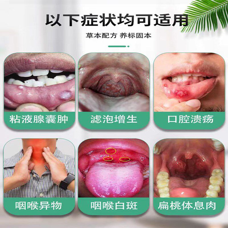 舌根淋巴滤泡增生扁桃体肥大喉咙有痰异物感嗓子干痒咳嗽草本喷剂