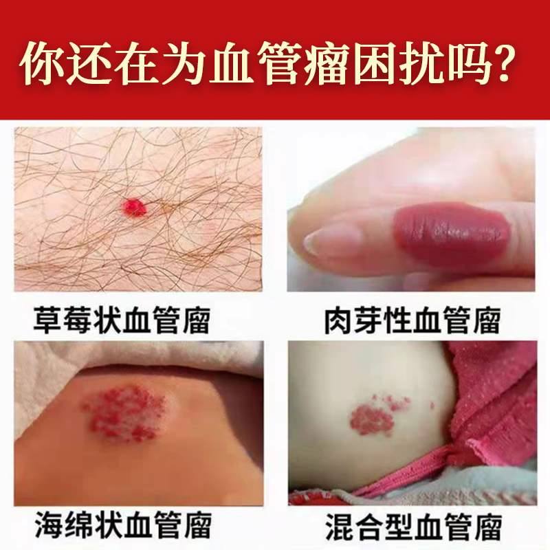 新品血管瘤婴儿外用药血管痣去除樱桃草莓海绵蔓状毛细血管修复乳