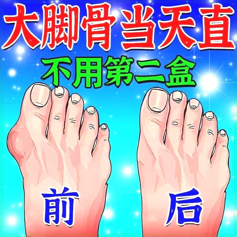 热销【不直全赔】大脚骨脚趾重叠专用膏贴拇外翻神器拇指外翻矫正