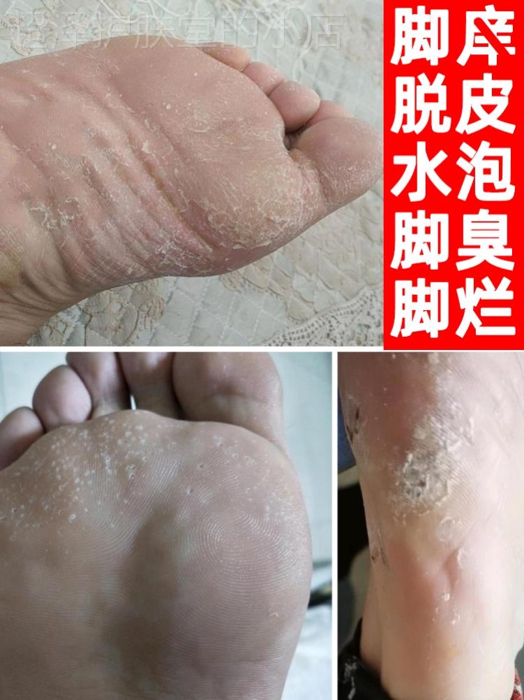 速发专用真菌感染手皮肤止痒喷雾草本湿疹汗状药膏去正品脱皮