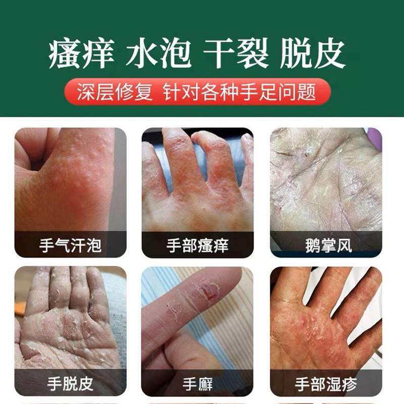 汗疱疹汗孢疹汗泡疱疹药用汉汗状疱疹手上小水泡克专鹅掌风星膏hj