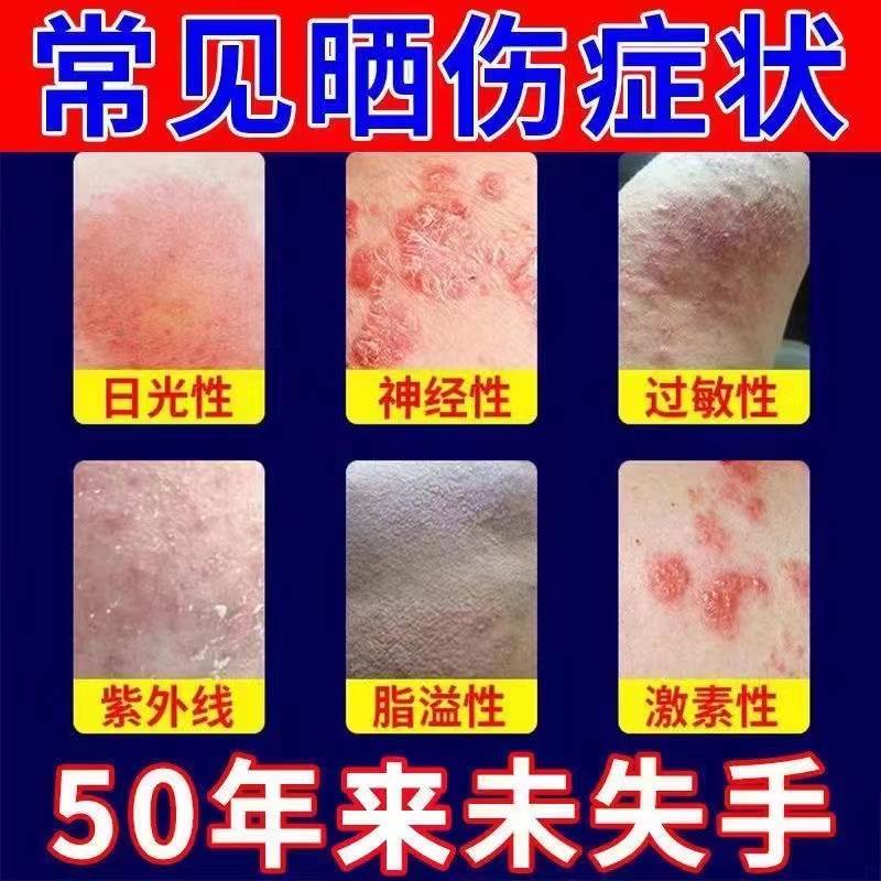 脖子红痒刺挠长红瘩疹子湿肿过敏性皮肤痒疙毒止痒膏