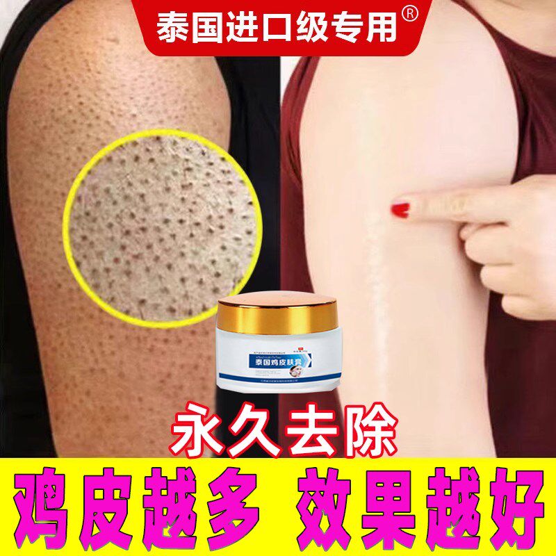 鸡皮肤疙瘩毛囊角化药膏去除神器皮肤霜克s星手臂腿部角质化