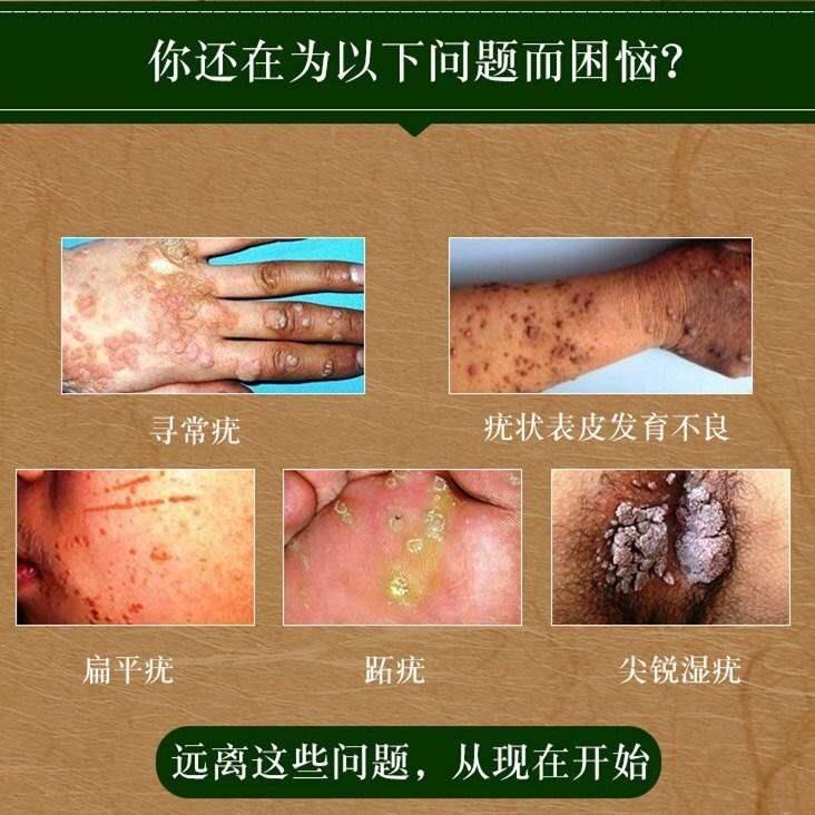 极速西疆域草克优液组合装去丝状忧脖子尖鋭湿尤乳膏克忧霜克疣液