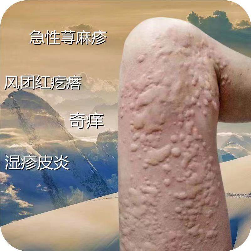 厂家严重荨麻疹身上痒起疙瘩风团型日光性皮炎胆碱性荨麻疹外用止
