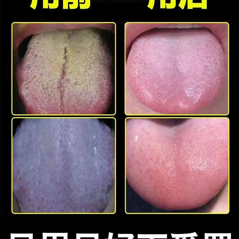速发100%根】舌苔厚白厚黄腻调理脾胃除m口臭口苦口干去湿气特效