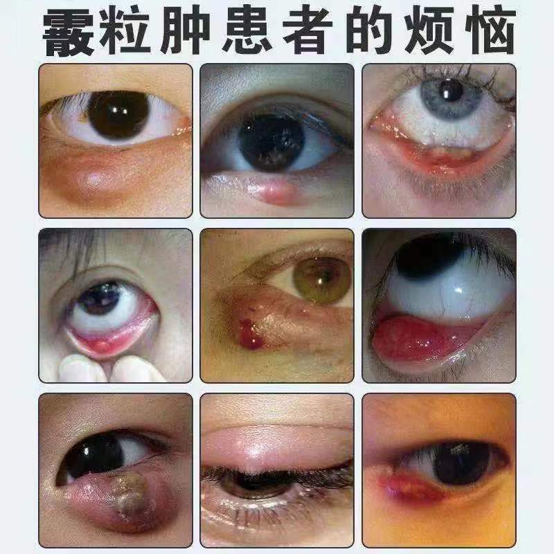 霰粒肿热敷眼膜麦粒肿膏眼皮红肿痒儿童眼睑板腺疏通消除散粒肿