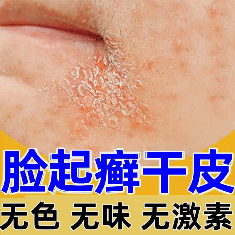 急速发货脸上长癣脸上癣脸痒起皮起皮乾燥脂溢性皮炎脸部皮肤过敏