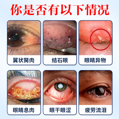 去除眼睛胬肉滴眼液长翼状息肉有C异物感模糊看不清眼干痒红血丝