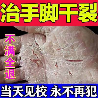 现货速发治手裂的药膏【快速愈合】手脚干裂脚后跟干燥粗糙脱皮修