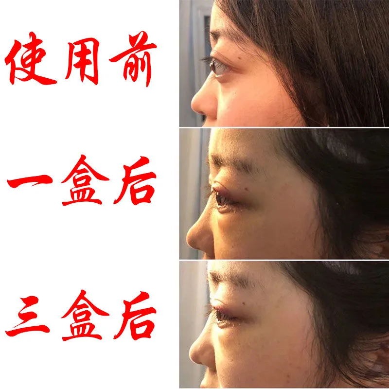 甲亢眼突眼膜专用药眼球突出矫正滴眼液眼睛凸调理桥本氏甲状腺炎