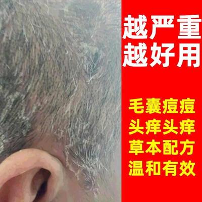 云南本草止痒灵真菌克星湿毒清软膏苗家癣药膏皮藓王W神龙百草止