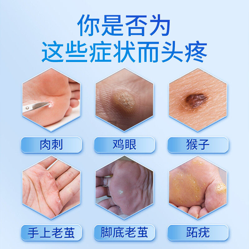 速发南京同仁堂鸡眼贴脚底长鸡眼肉刺脚上长硬疙瘩脚趾头老茧硬块