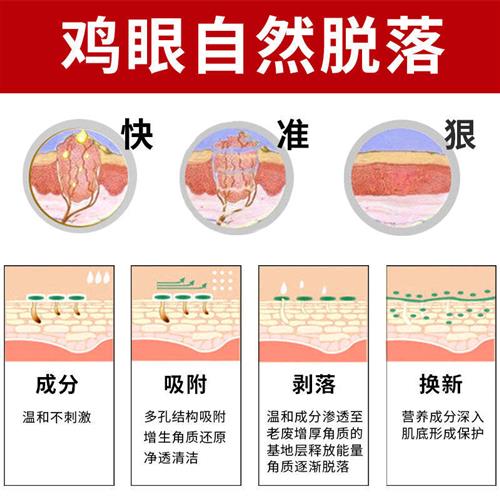新品鸡眼消鸡尤清无痛去肉刺瘊子祛鸡眼膏贴老茧关节茧跖疣脚底脚
