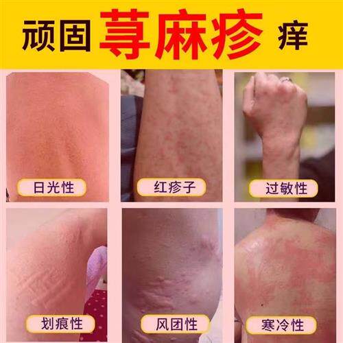 现货速发荨麻疹药膏急慢过敏风团型胆硷性划痕性皮肤瘙痒特应性皮