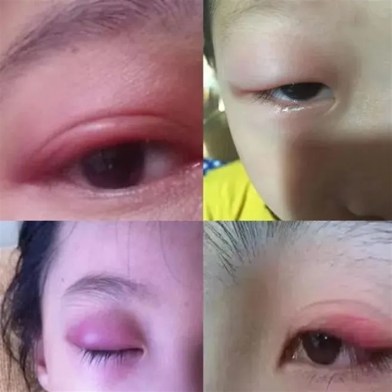 眼皮红肿痒专用过敏消炎杀菌止痒消除散粒肿麦粒肿草本熊胆眼膏.