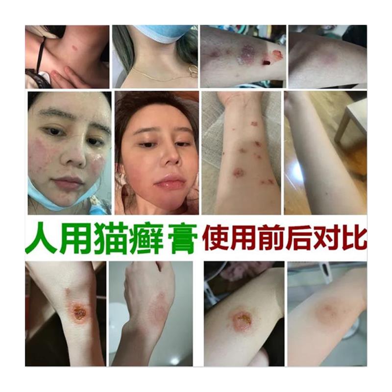人用猫癣药人得猫癣专用药皮肤癣红疹快速止痒药人感染猫癣的药膏