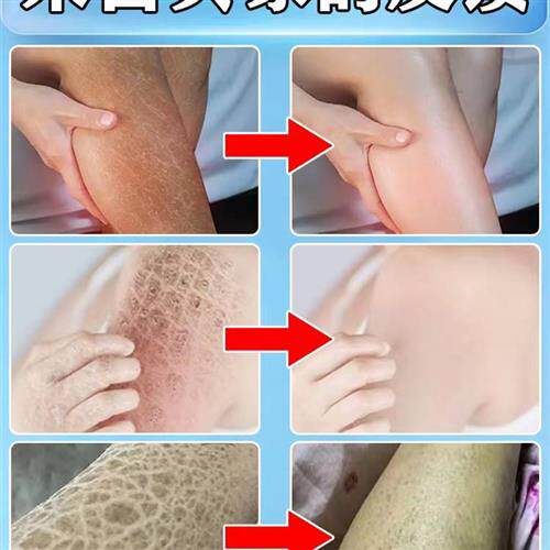 鱼鳞皮肤霜鱼鳞腿克星成人儿童祛除皮肤乾燥蜕皮疙瘩角质化药膏