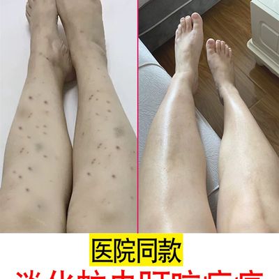 痕咬祛疤膏蚊男疤叮痘痘修复B去除淡化黑色素痘印子女疤印