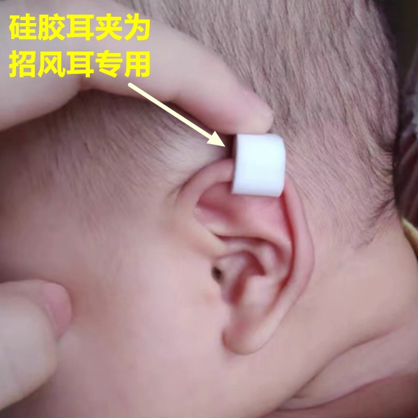耳廓矫形器矫正器畸形招风耳