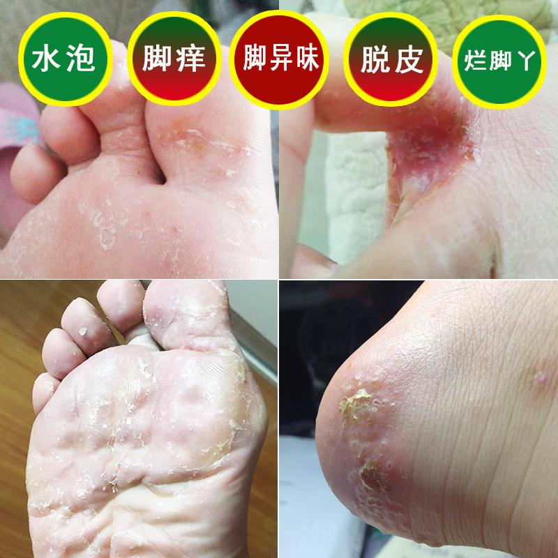 足光粉一次净对脚痒水泡脱皮脚丫痒脱皮泡脚粉脚部问题杀菌止痒膏