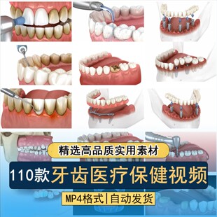 牙科牙齿医疗保健蛀牙拔牙洗牙补牙镶牙种植假牙口腔健康视频素材
