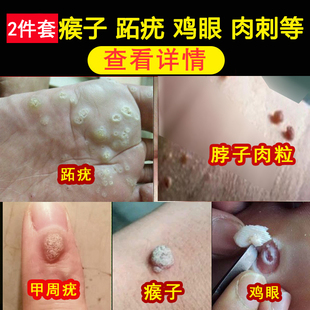 跖疣寻常疣专用膏病毒疣去除手部侯子趾疣脖子肉粒丝状疣根神器