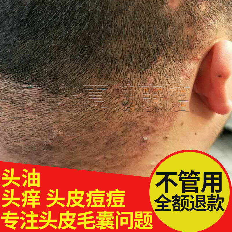 头皮护理毛囊洗炎去螨虫除螨神器洗发水露专用去头屑止痒深层清洁