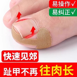甲沟矫正器嵌甲矫正贴片往肉里长专用隔离纠正脚趾甲填充垫神器