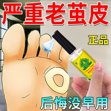 【无疼脱落茧】老茧脚茧关节茧手茧脚底