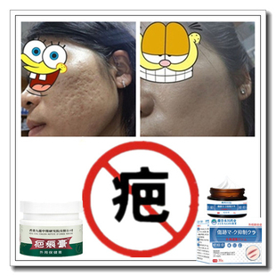 消除烟疤去手术产后凹凸增生性疙瘩淡化开伤疤痕印灵色素撞伤药膏