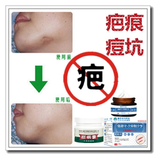 修复消除增生性疙瘩软化冻疮去手术凹凸产后祛开刀刮伤巴痕灵药液